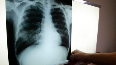 Photo of República Dominicana registró más de tres mil casos de tuberculosis en 2021